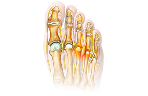 Morton's syndrome