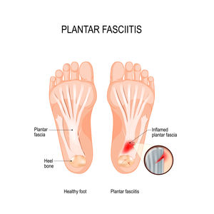 What is the Plantar Fasciitis?